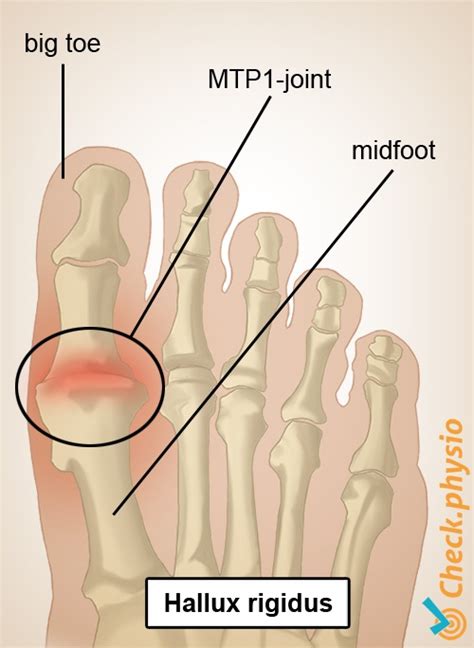 Big Toe Joint Pain