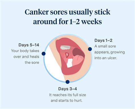 Biggest Canker Sore