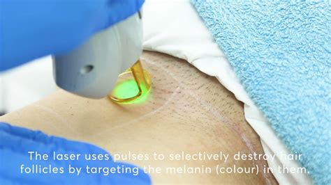 Bikini Line Laser Hair Removal