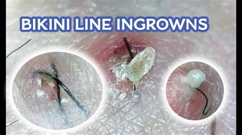 Bikini Zone Ingrown Hair