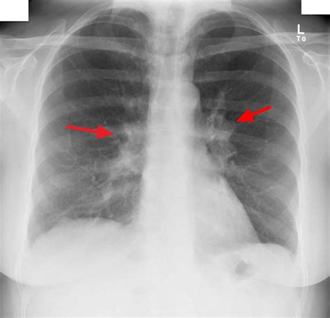 Bilateral Hilar Adenopathy