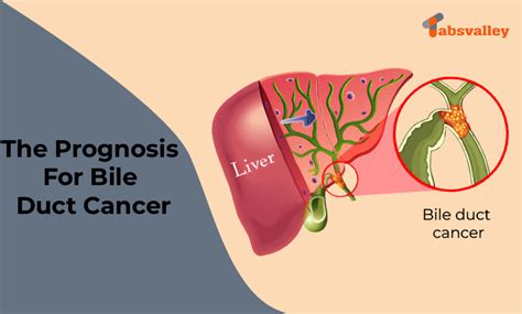 Bile Duct Cancer Prognosis