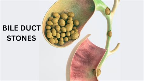 Bile Duct Stones