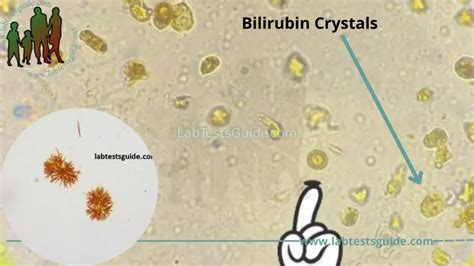 Bilirubin Crystals In Urine