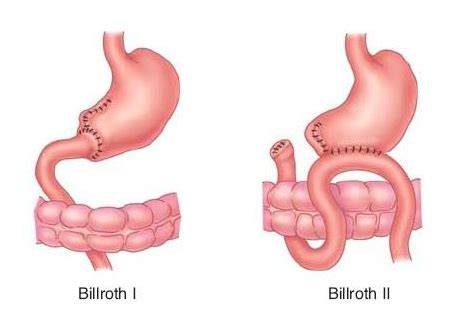 Billroth's Operation Ii
