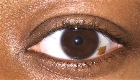 Birthmark On The Eyeball