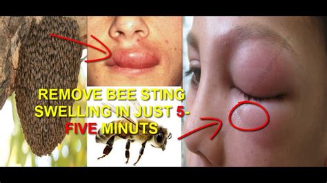 Bite Of Honey Bee