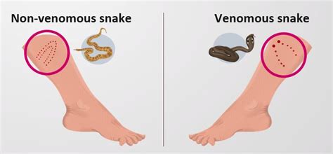 Bite Of Venomous And Non Venomous Snake