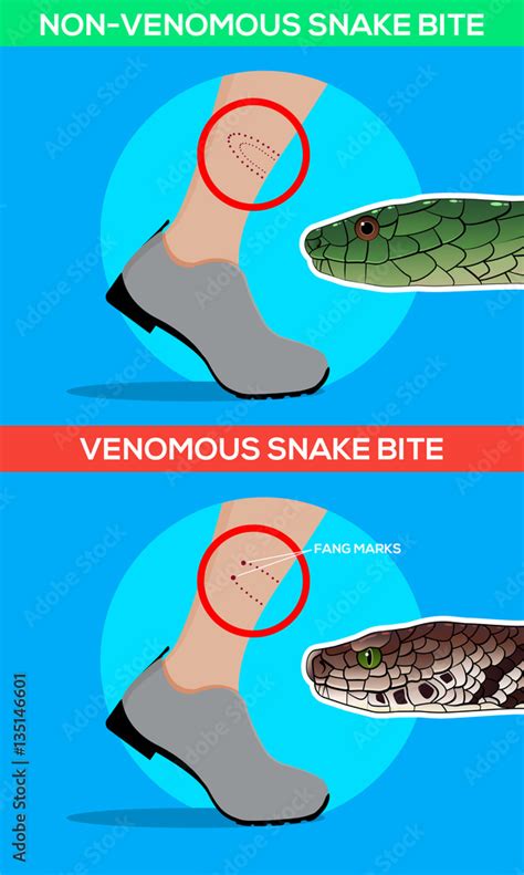 Bite Of Venomous Snake