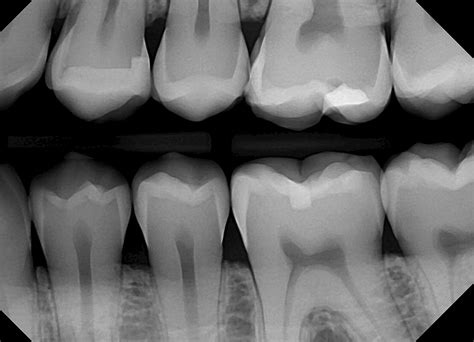 Bitewing X Ray