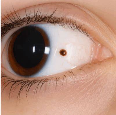 Black Dot In Eye
