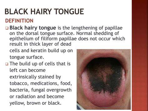 Black Hairy Tongue Images