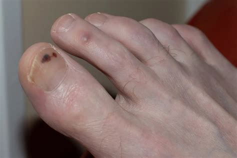 Black Spot Nail