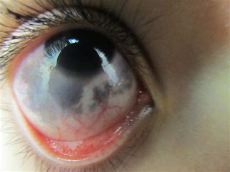 Black Spot White Of Eye