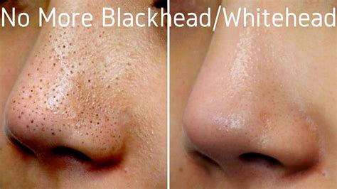 Blackhead Removal Nose