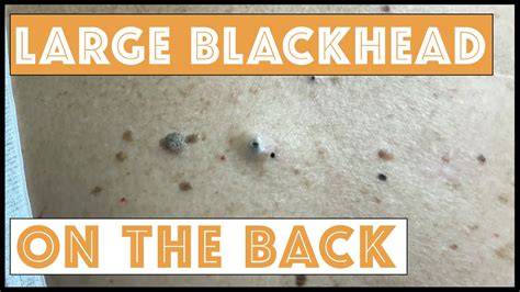 Blackheads On Back
