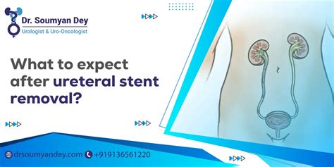 Bladder Stent Removal
