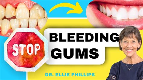 Bleeding Gums Treatment