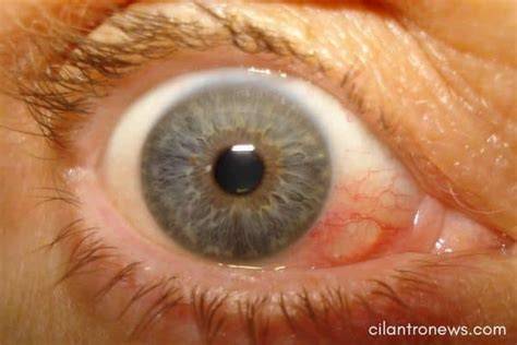 Blister On Eyeball