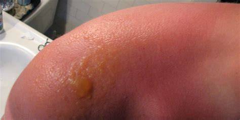 Blisters From Sunburn