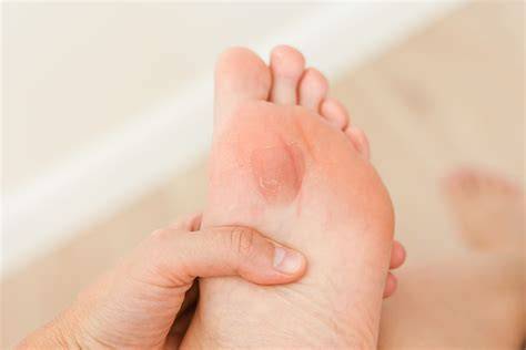 Blisters On Feet