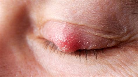 Blocked Oil Gland Eyelid