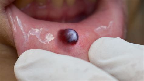 Blood Blister On Lip