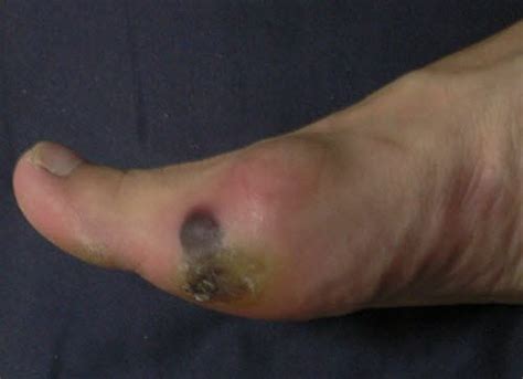 Blood Blister On Toe