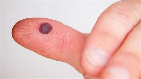 Blood Blister Should You Pop