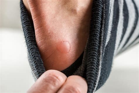 Blood Blisters On Feet