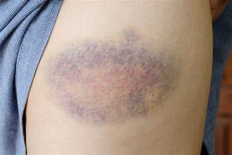 Blood Clotting Bruises