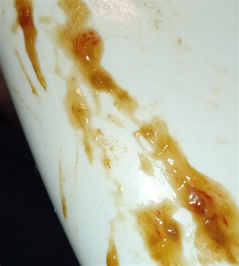 Blood Mucus Stool