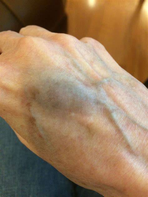 Blood Vessel In Wrist Burst