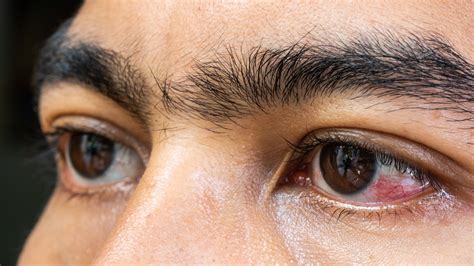 Bloodshot Eye On One Side