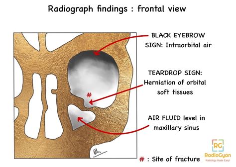 Blow Out Fracture
