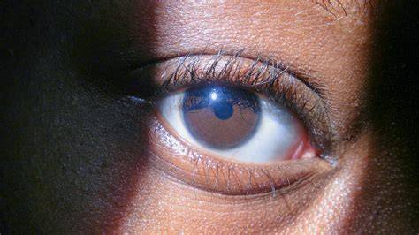 Blue Circle Around Eye
