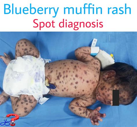 Blueberry Muffin Rash