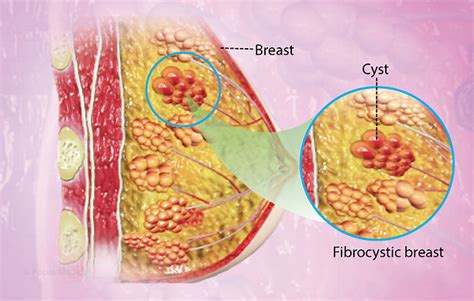 Bluedomed Cyst Fibrocystic Disease