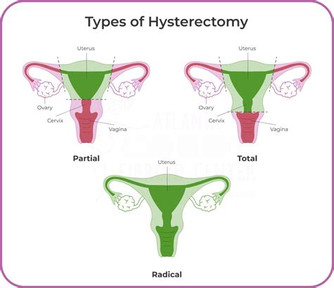 Body Changes After Uterus Removal
