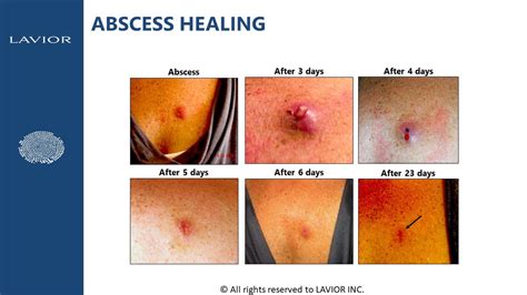 Boil Vs Abscess