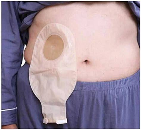 Bolsa De Colostomia