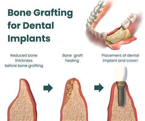 Bone Grafting For Dental Implants