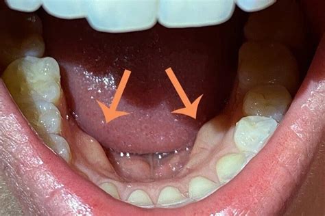 Bone Growth In Mouth