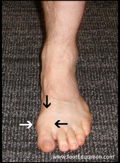 Bone Spur On Big Toe