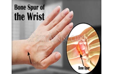 Bone Spur On Wrist Joint
