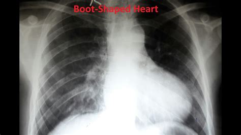 Boot Shaped Heart