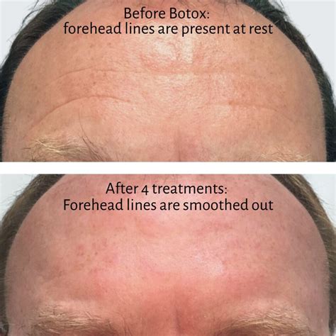 Botox Forehead Wrinkles