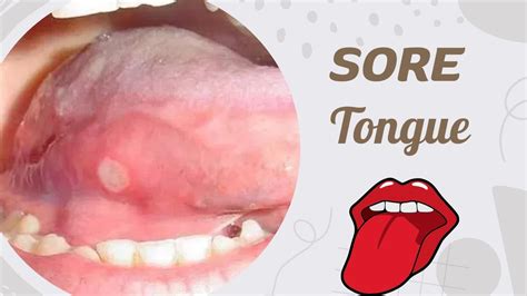 Bottom Of Tongue Hurts