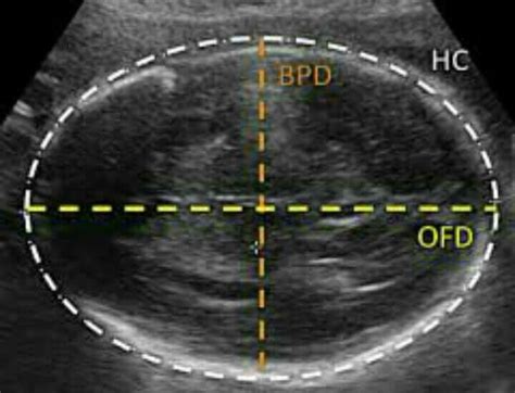 Bpd Ultrasound Meaning