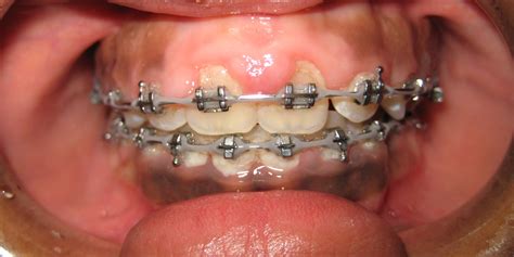 Braces And Gum Swelling